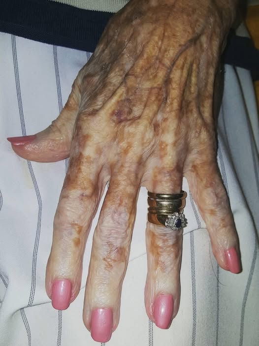 Nurse takes photo of old lady’s hand – then sees detail in the picture that has the internet exploding