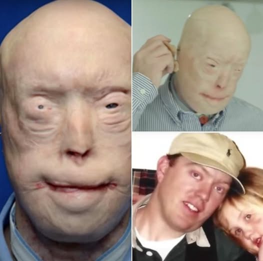 From tragedy to recovery: firefighter with severe burns 7 years on. - Likya