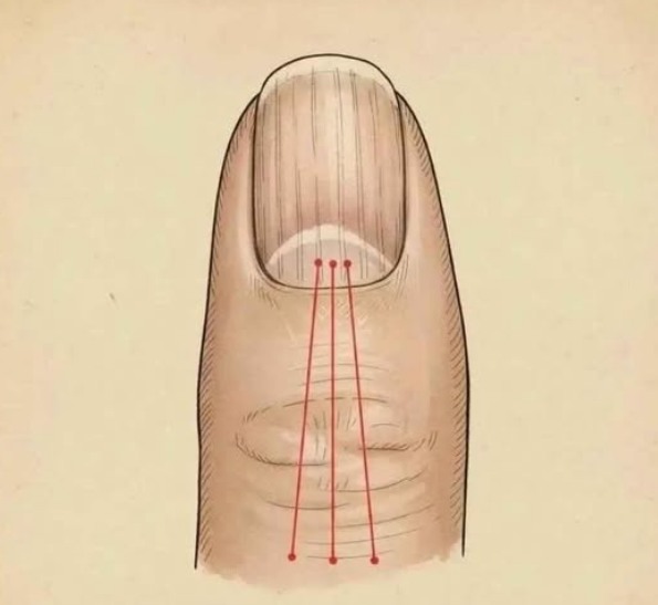 If you have lines on your nails, it means you have...