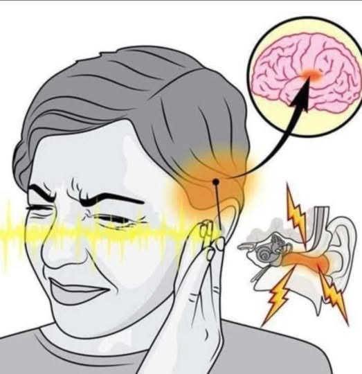 If you hear ringing in your ear, this is a sign that you will suffer from…