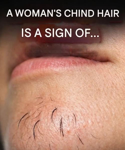 A woman’s chin hair is a sign of...
