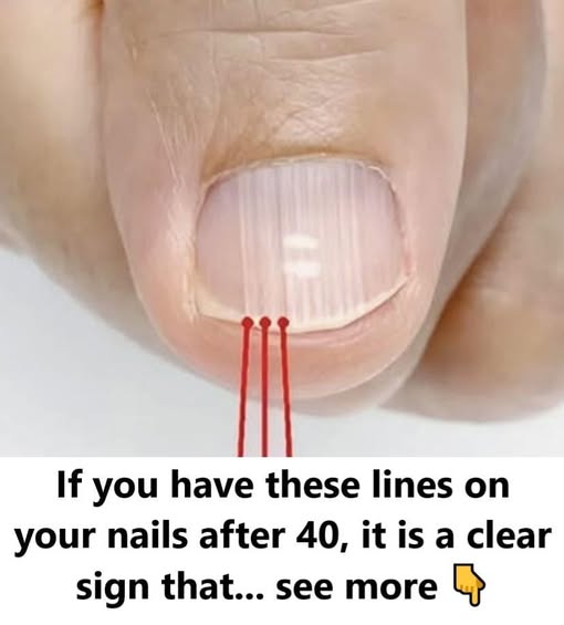 If you have these lines on your nails after 40, it is a clear sign that...