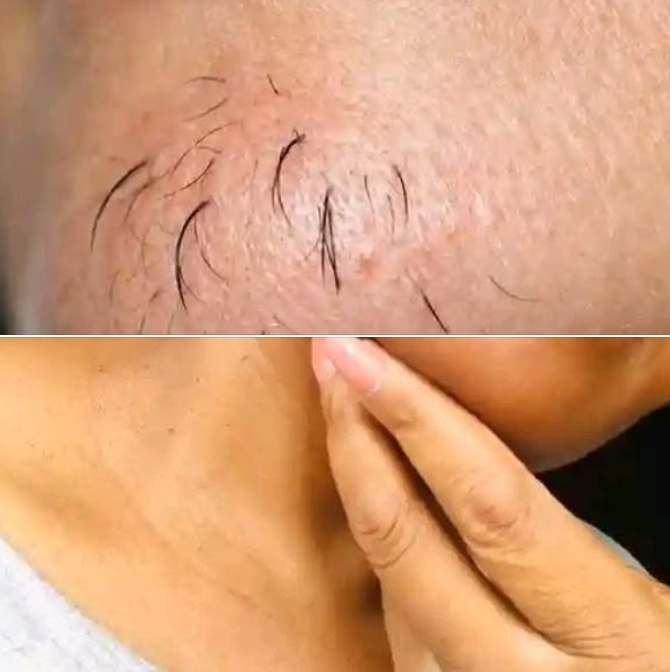 Understanding Common Reasons For Chin Hair Growth In Women...