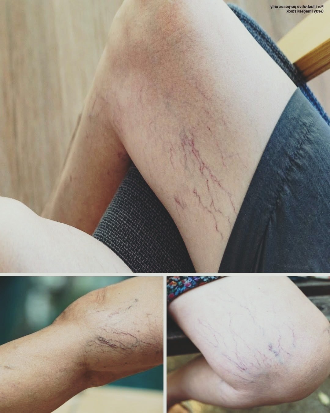 What Your Purple Leg Veins Might Be Telling You About Your Health