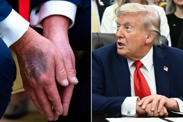 Shock 🚨🚨Trump’s Condition Has Escalated to…See more