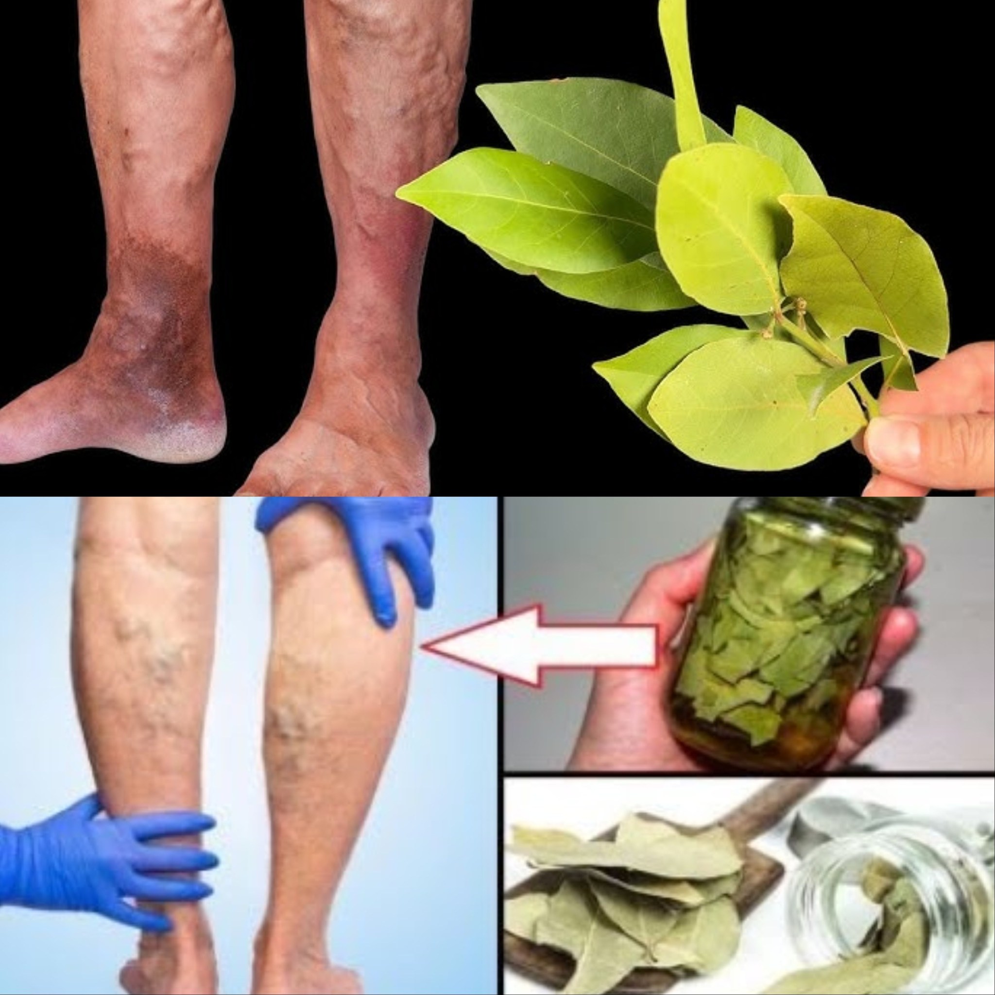 Unbelievable! Get rid of varicose veins with bay leaf! This treasure should be in every home