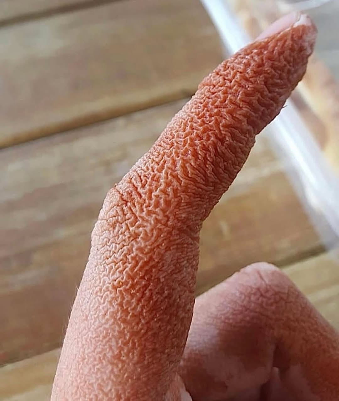 Clinical Presentation and Management of Sweet Syndrome: A Case Report