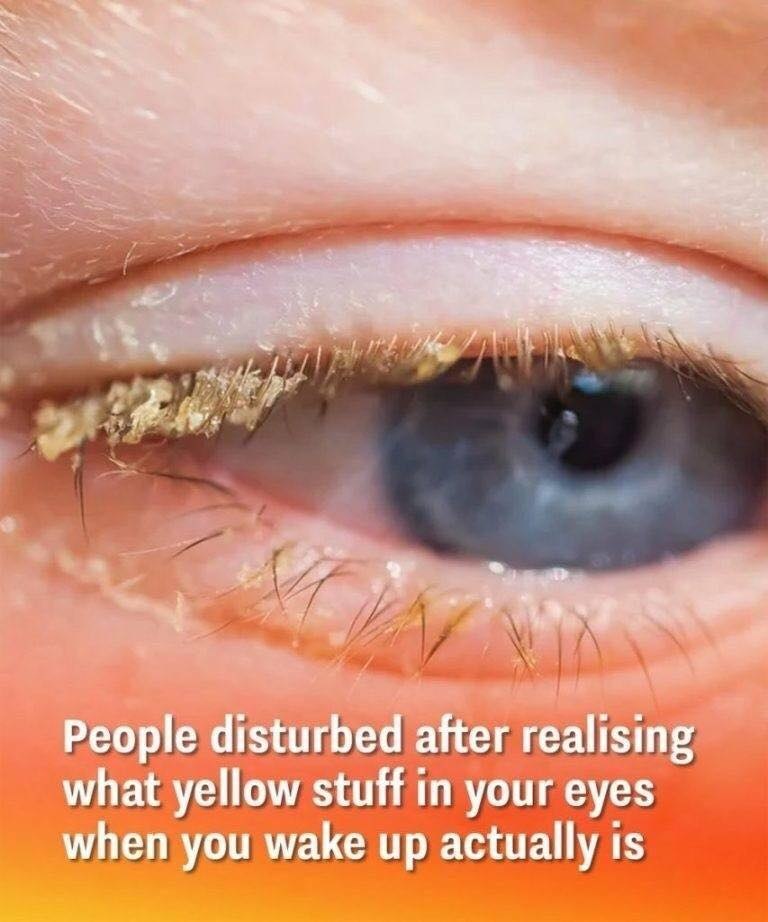 People disturbed after realising what yellows stuff in your eyes when you wake up actually is