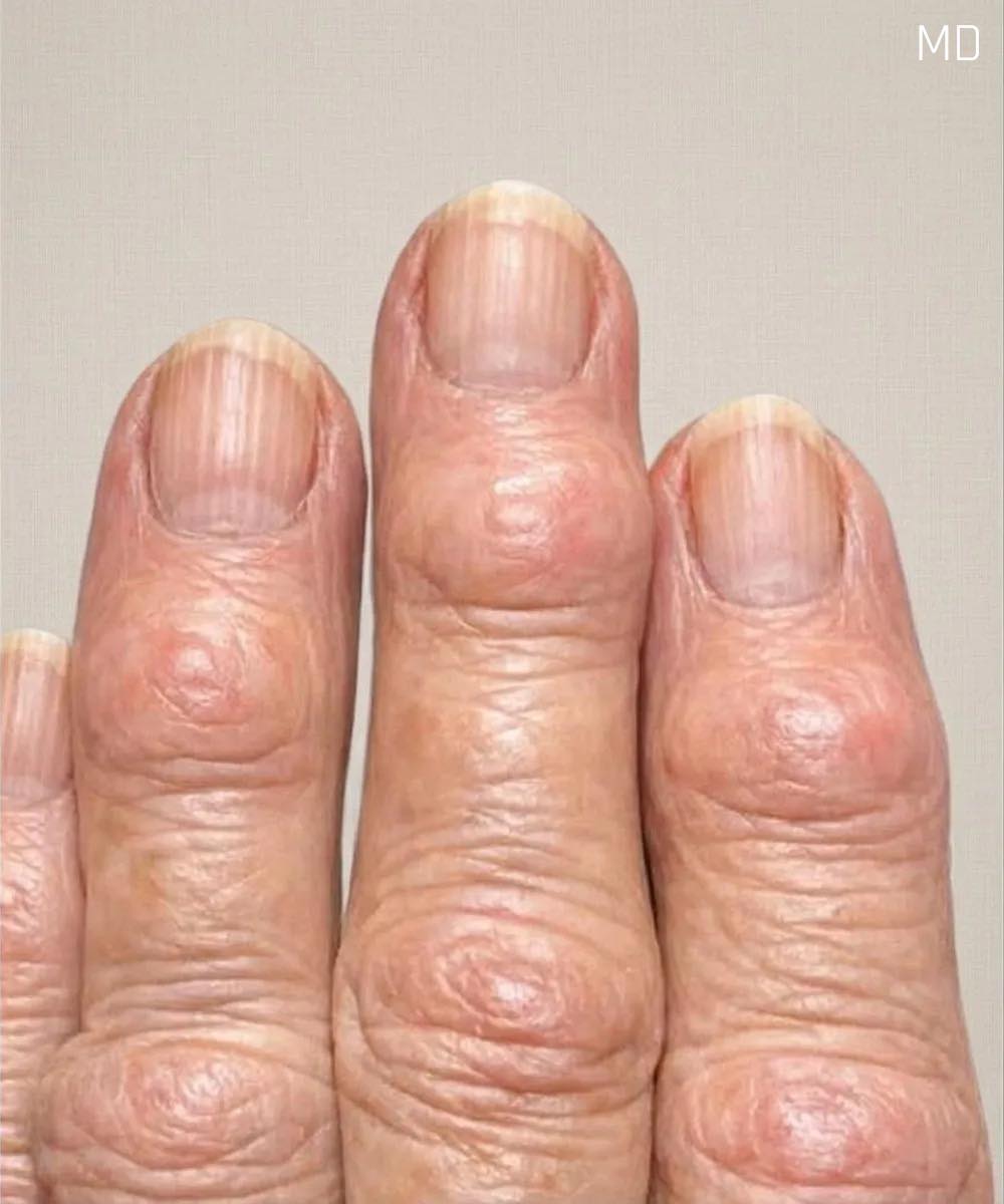 My grandma has these hard bumps forming on her finger joints near the nails. Why is this spreading?