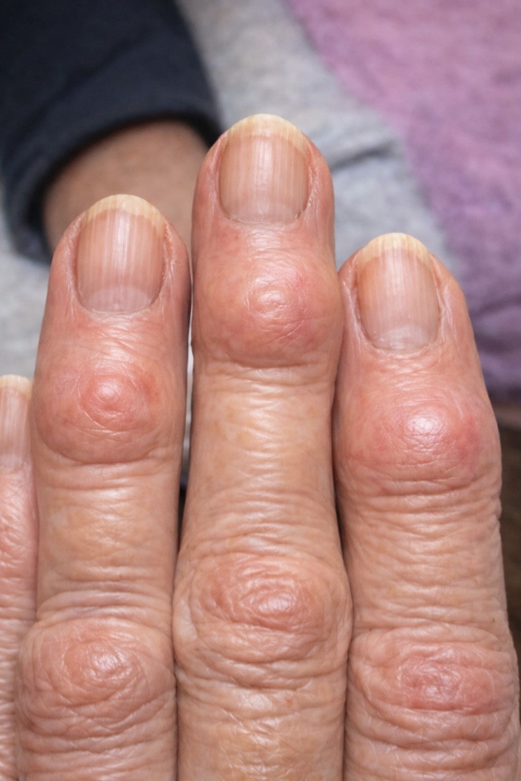 My grandma has these hard bumps formings on her finger joints near the nails. Why is this spreading?