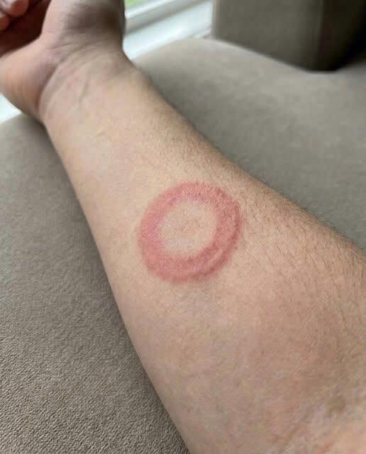 5 Simple Home Remedies to Prevent Ringworm and Keep Your Skin Healthy