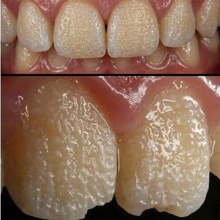 Be Careful! This Is What Can Happen to Your Teeth When You Eat Certain Everyday Foods and Drinks That Slowly Damage Enamel, Cause Staining, Increase Sensitivity, and Lead to Long-Term Dental Problems You Might Not Notice Until It’s Too Late to Reverse the Effects