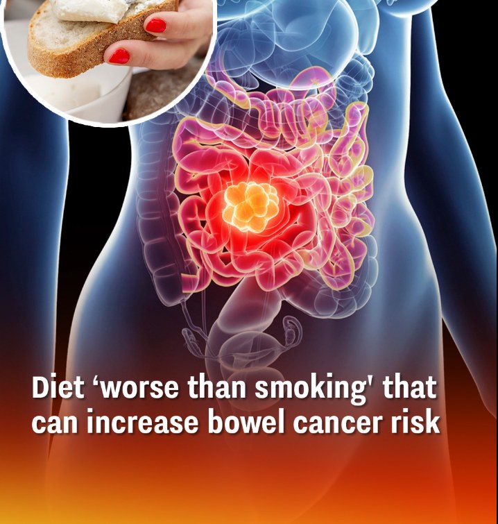 Diet ‘worse than smoking’ that can increase bowel cancer risk