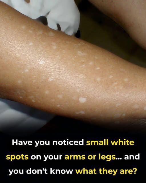 Small White Spots on Arms and Legs You Need To Know - All easy recipes