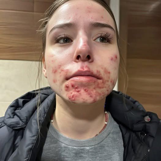 The Hidden Reasons You Keep Getting Pimple on Your Chin