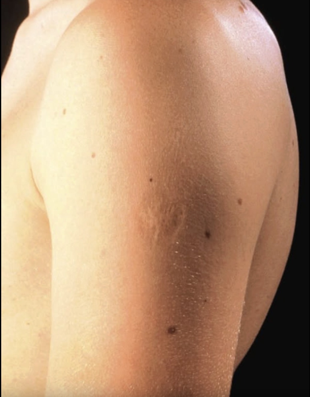 Smallpox vaccine scars: What they look like and why