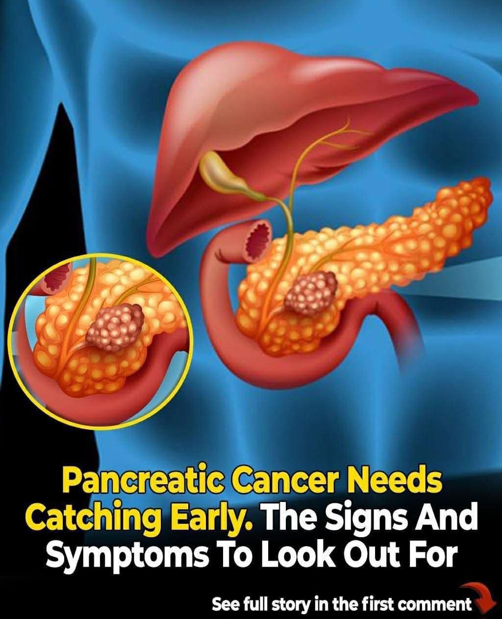 Signs of pancreatic cancer you should never ignore Read More