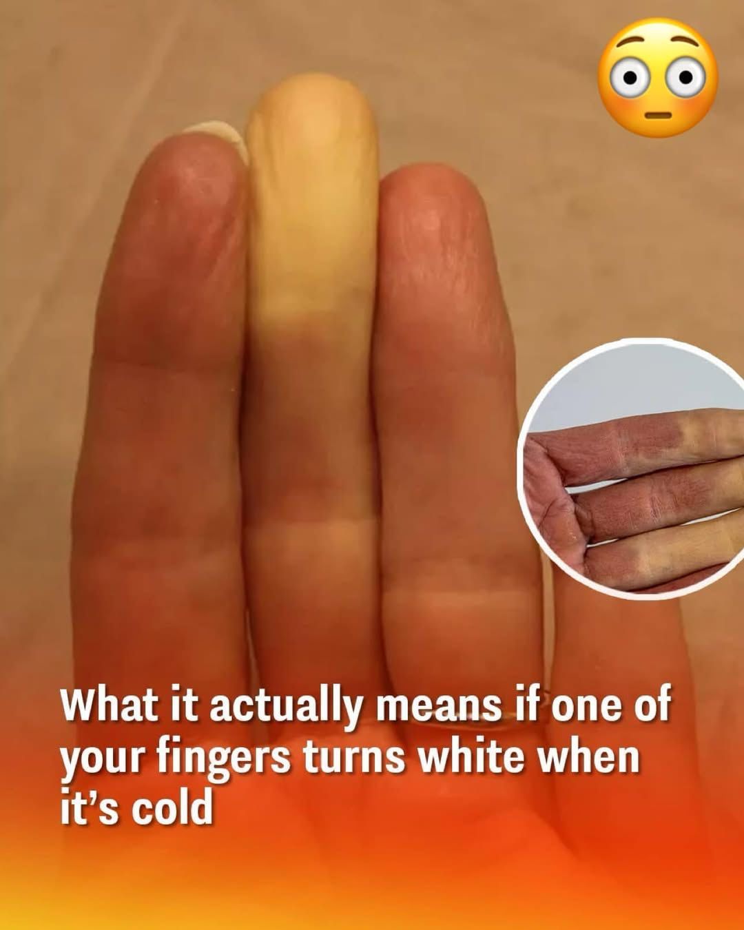 Raynaud’s Phenomenon: Why Fingers Turn White in the Cold