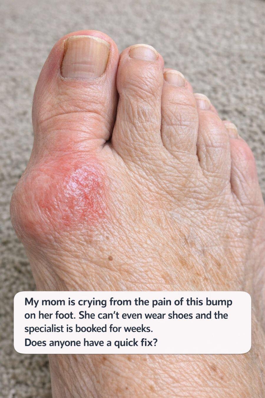 My mom is crying from the pain of this bump on her foot. She can’t even wear shoes and the specialist is booked for weeks. Does anyone have a quick fix?