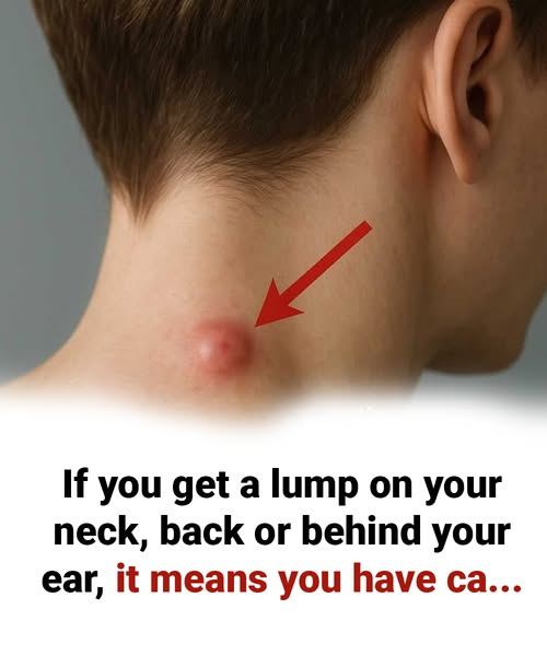 Got a lump on your neck, back or behind your ear? This is what you need to know