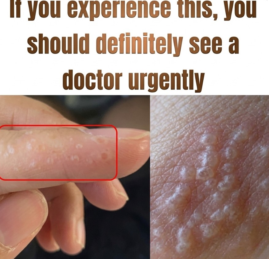 Painful Red Bumps on Your Hands or Feet? It Could Be Dyshidrotic eczema—Experts Explain the Symptoms, Triggers, and Treatment Options, Highlighting How This Skin Condition Can Cause Itching, Blisters, and Discomfort, and Why Early Care, Proper Diagnosis, and Skin Protection Are Important to Manage Flare-Ups and Prevent Recurrence