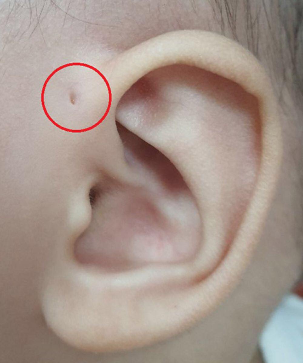 Discover the meaning of this particular mark on the ear. Han ttBy Han tt01/04/20262 Mins Read Share If you’ve ever noticed someone with a small mark or tiny hole near their ear and assumed it came from an injury, it’s actually something different. It’s a genetic trait—and here’s what it may mean.