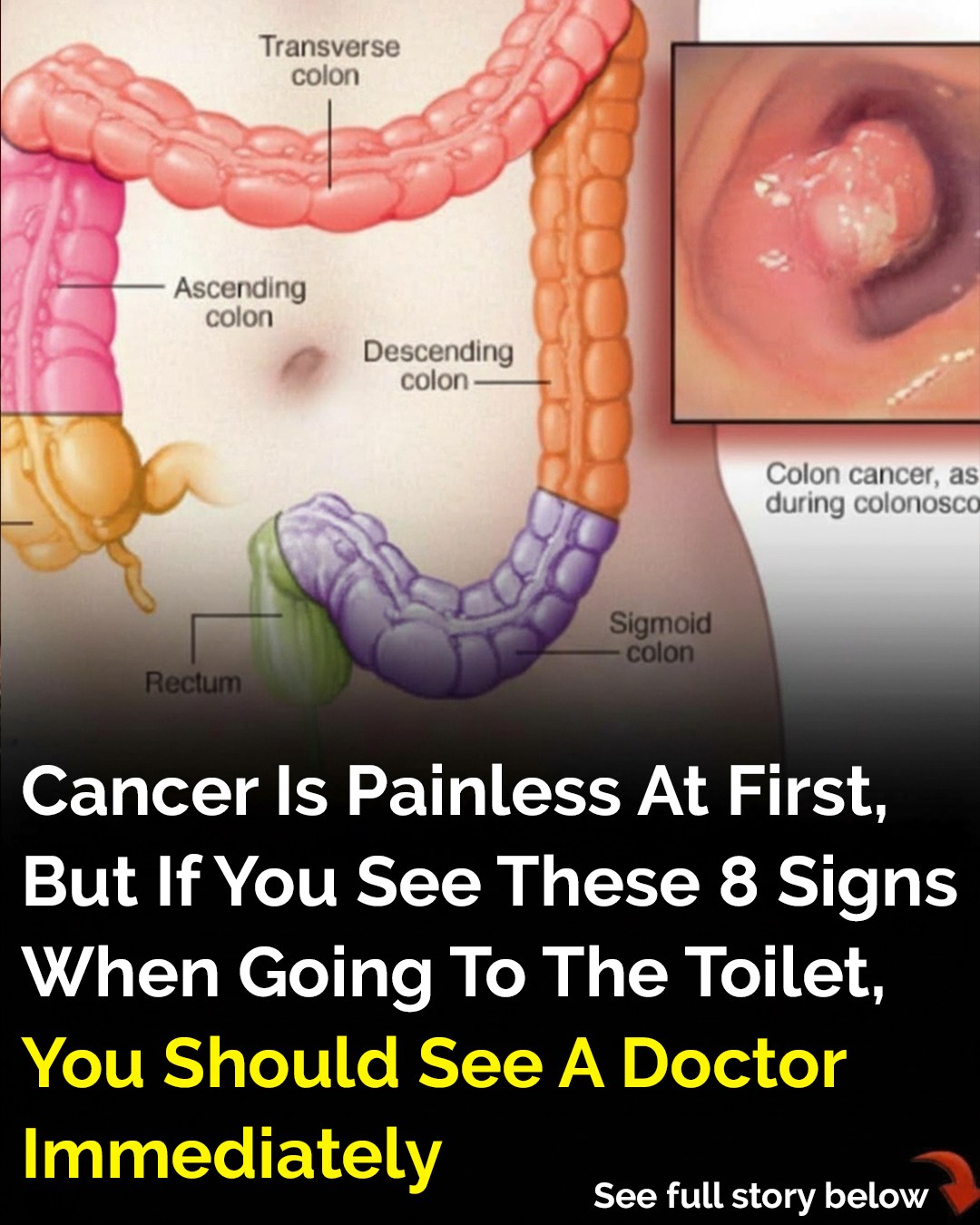 How Your Bowel Movements Reveal Clues About Colon Cancer