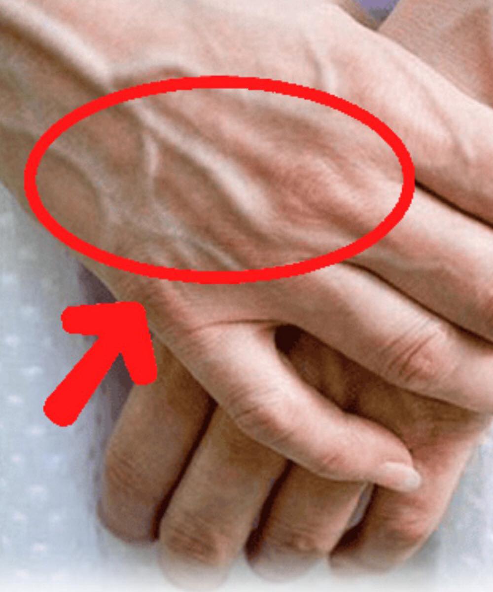 If you have visible veins, it means you are…  Mins Read Share If Someone Has Visible Veins, Does It Mean Their Circulation Is Poor?