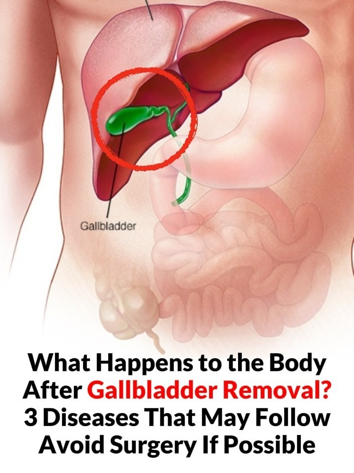 What Happens to Your Body After Gallbladder Removal? (And When Surgery Is Actually Necessary)