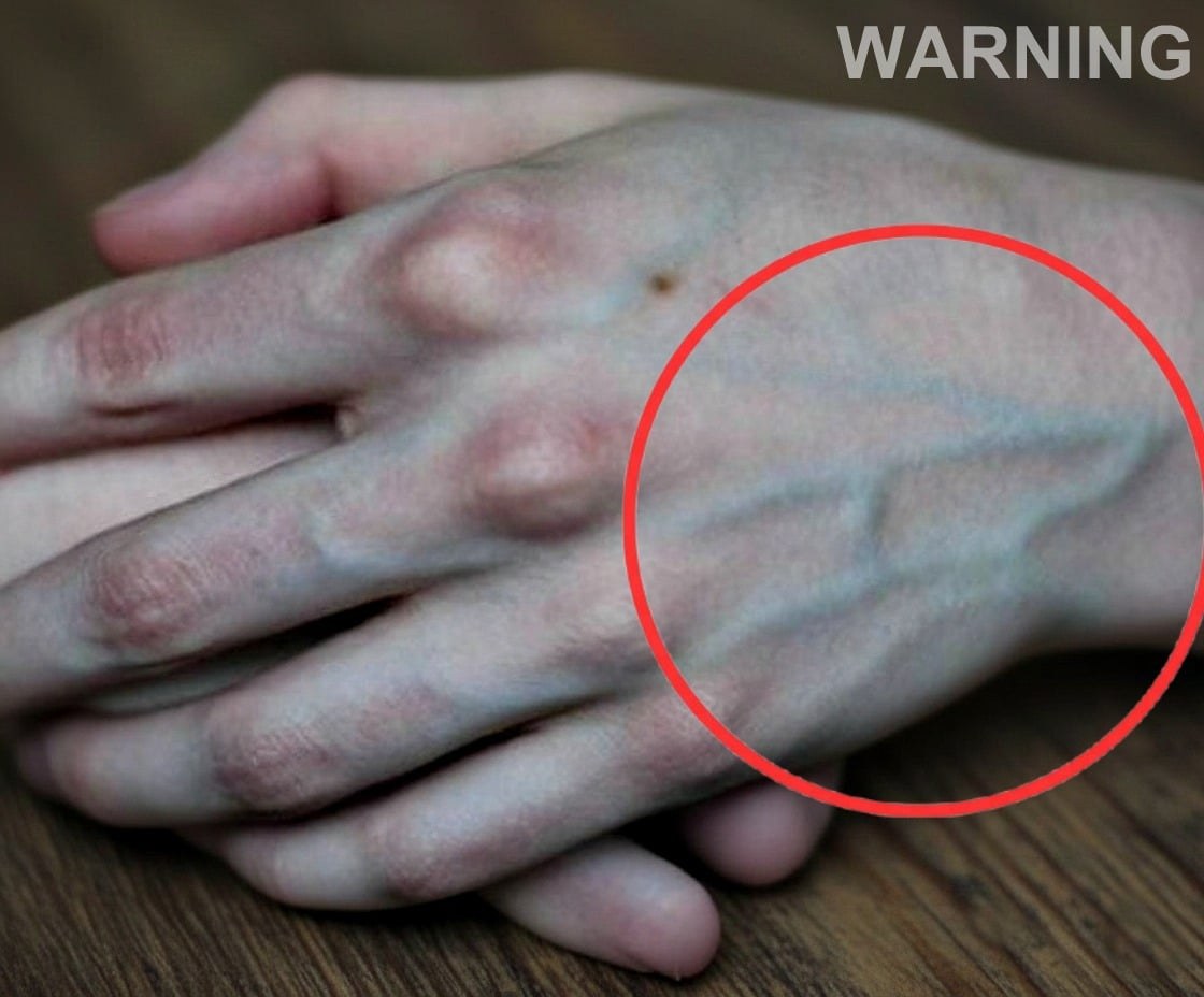 If your veins are visible in your hand, it is a signal of ca… See more👇🏻