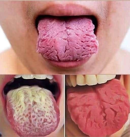 What Changes in Your Tongue May Say About Your Overall Well-Being