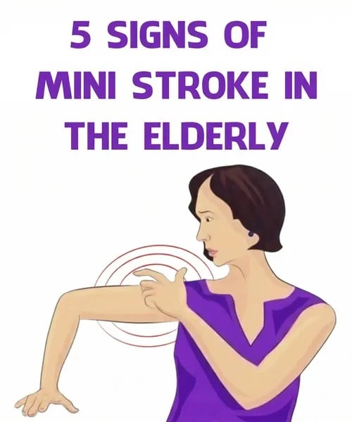 Mini Stroke in the Elderly: Common and Overlooked Symptoms