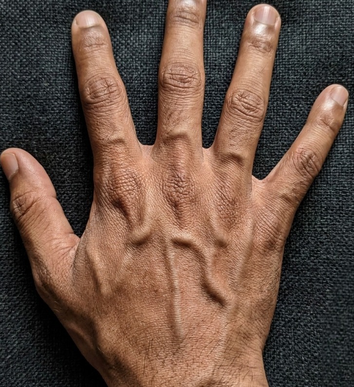Visible Hand Veins Explained: Why They Appear, From Low Body Fat, Genetics, Exercise, Heat, and Hydration Changes, and When They Are Normal or Rarely a Sign of Medical Concern, Offering Reassurance That Prominent Veins Are Usually Harmless Physical Traits While Highlighting Simple Lifestyle Factors That Influence Their Appearance Over Time Naturally and safely understood today