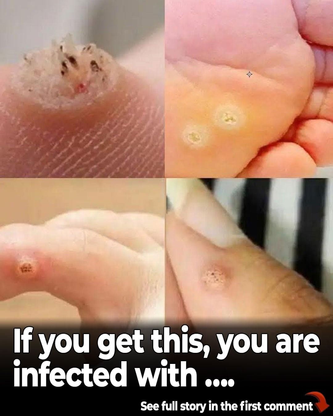 6 Types of Warts (Signs, Symptoms, Home Remedies, and Treatment)