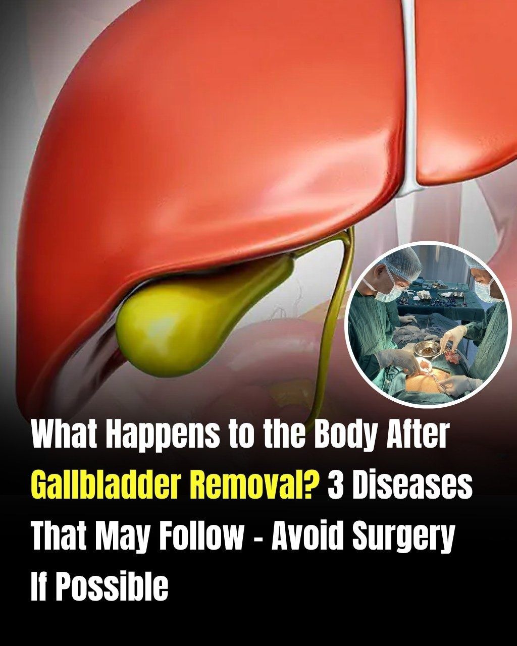 Life After Gallbladder Removal: Understanding the Possible Health Effects