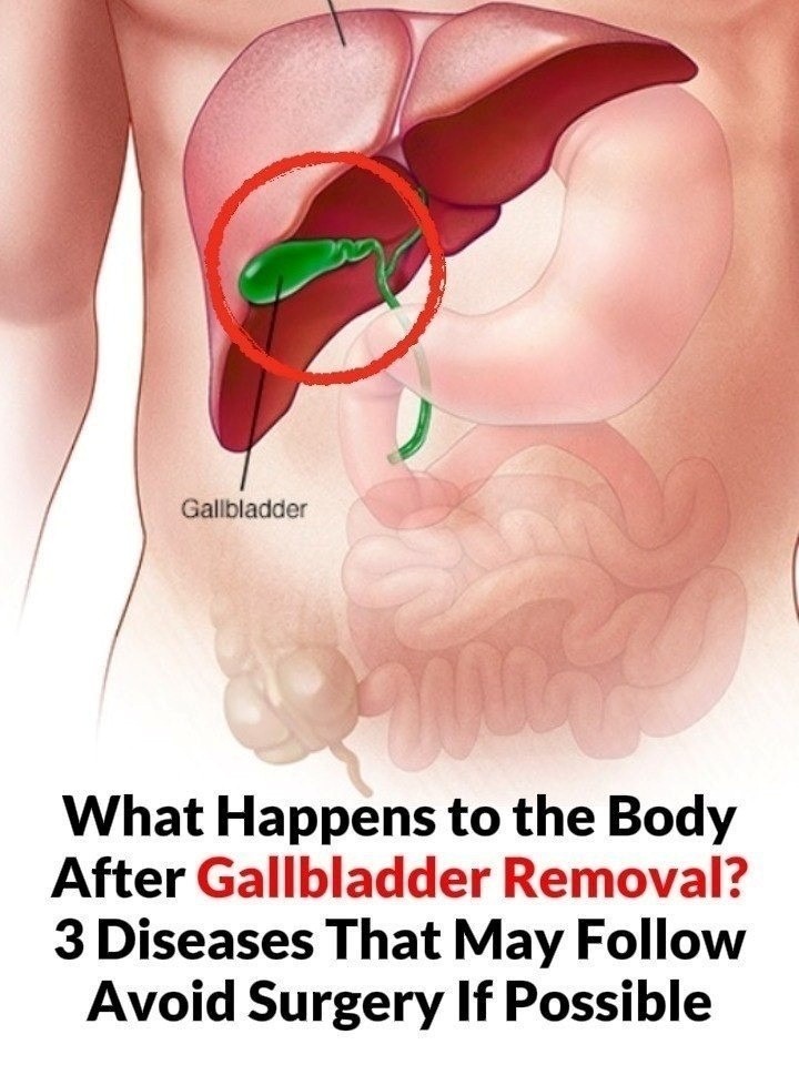 What Happens to the Body After Gallbladder Removal? 3 Diseases That May Follow – Avoid Surgery If Possible