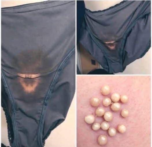 Some people are just finding out why they get bleach patches on their underwear