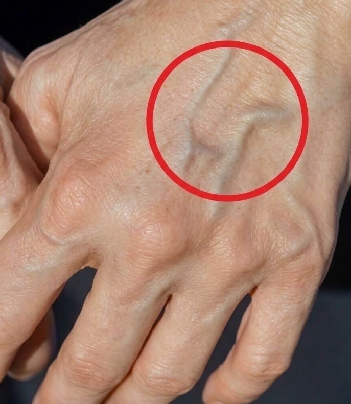 The veins on your hands can sometimes hint at kidney health. Prominent or unusually colored veins may indicate circulation issues, fluid retention, or underlying kidney problems. While vein appearance alone isn’t diagnostic, changes combined with swelling, fatigue, or urine changes could signal concern. Consulting a healthcare professional ensures accurate assessment and early detection of potential kidney issues