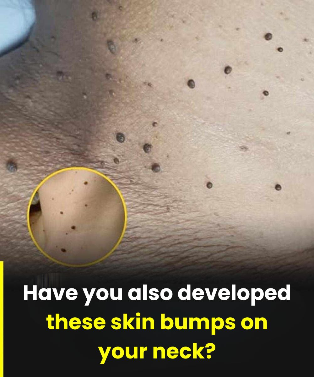Why Skin Tags Appear: 6 Common Reasons Dermatologists Often Explain
