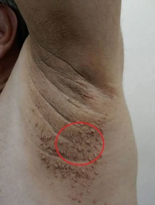 Dark Patches on the Neck? Understanding Acanthosis Nigricans and Its Link to Diabetes