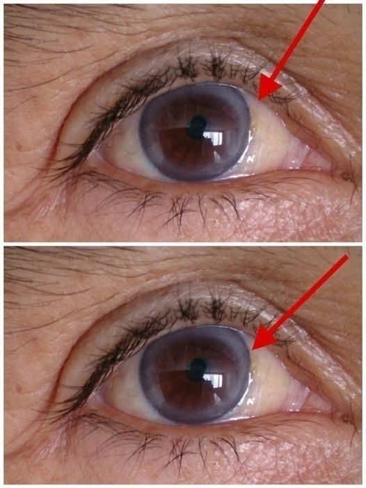 A Gray Ring Around the Eye? It Could Be More Than Just Aging