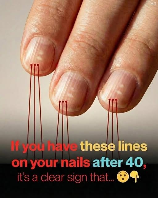 Why Vertical Lines on Your Nails Often Appear With Age