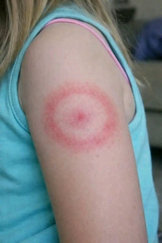 How to identify and cure skin fungus or ringworm.