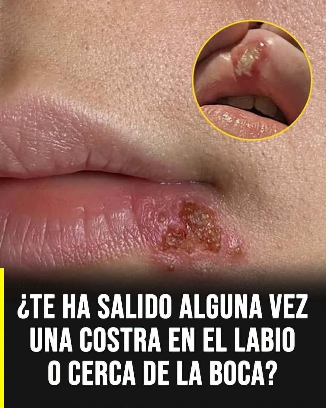 ¿Cómo prevenir la aparición del herpes labial?