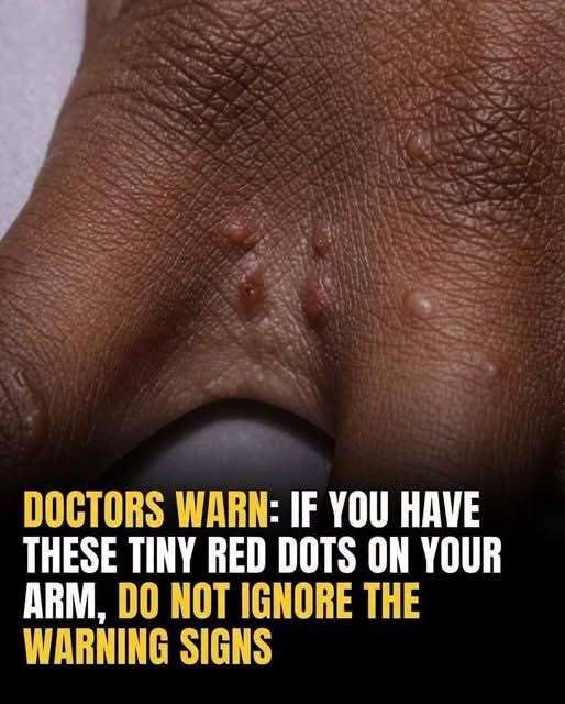 Is That Itchy Rash on Your Hands Actually a Hidden Danger? The Secret Signs of Dyshidrotic Eczema You Can’t Afford to Ignore
