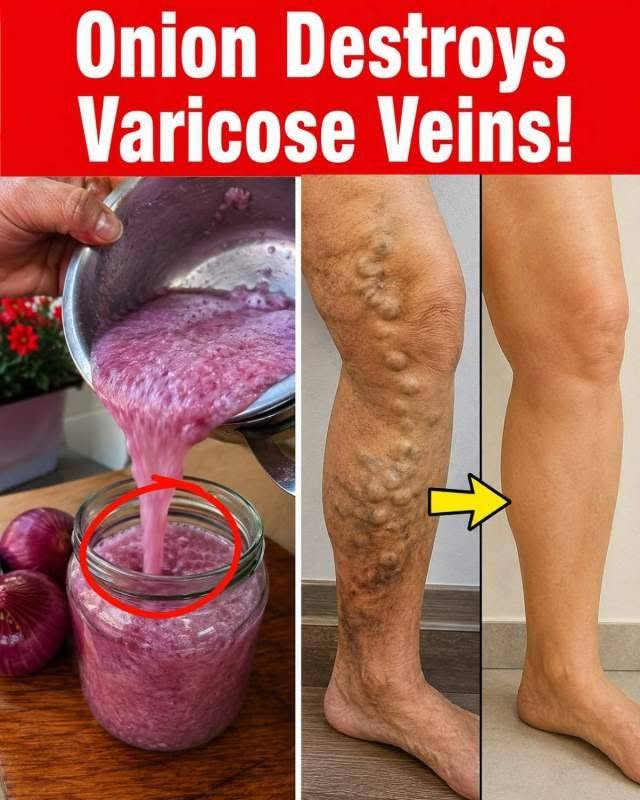 What Onion, Garlic, and Ginger Trigger Inside Bulging Veins