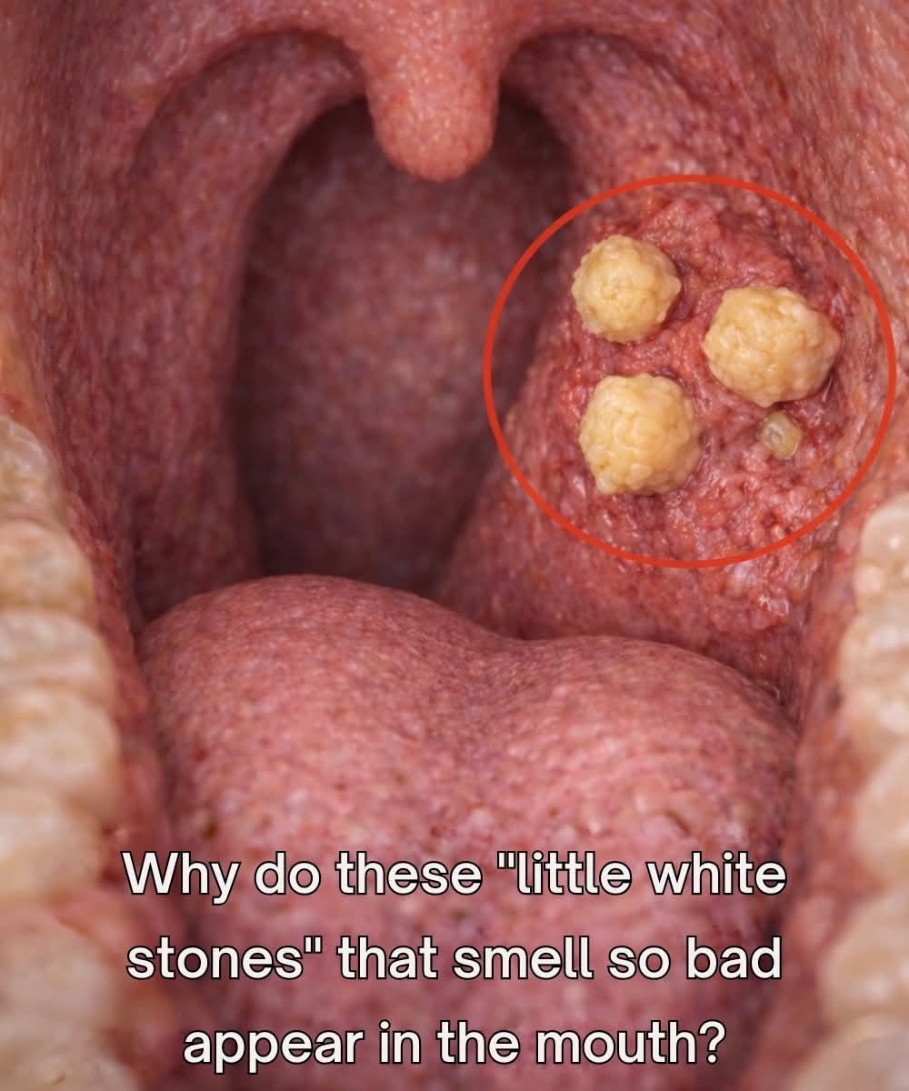 What Are Those Small White Stones in Your Throat That Cause Bad Breath?