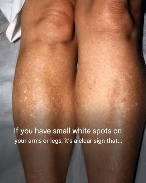 If you have small white spots on your arms or legs, it’s a clear sign that…