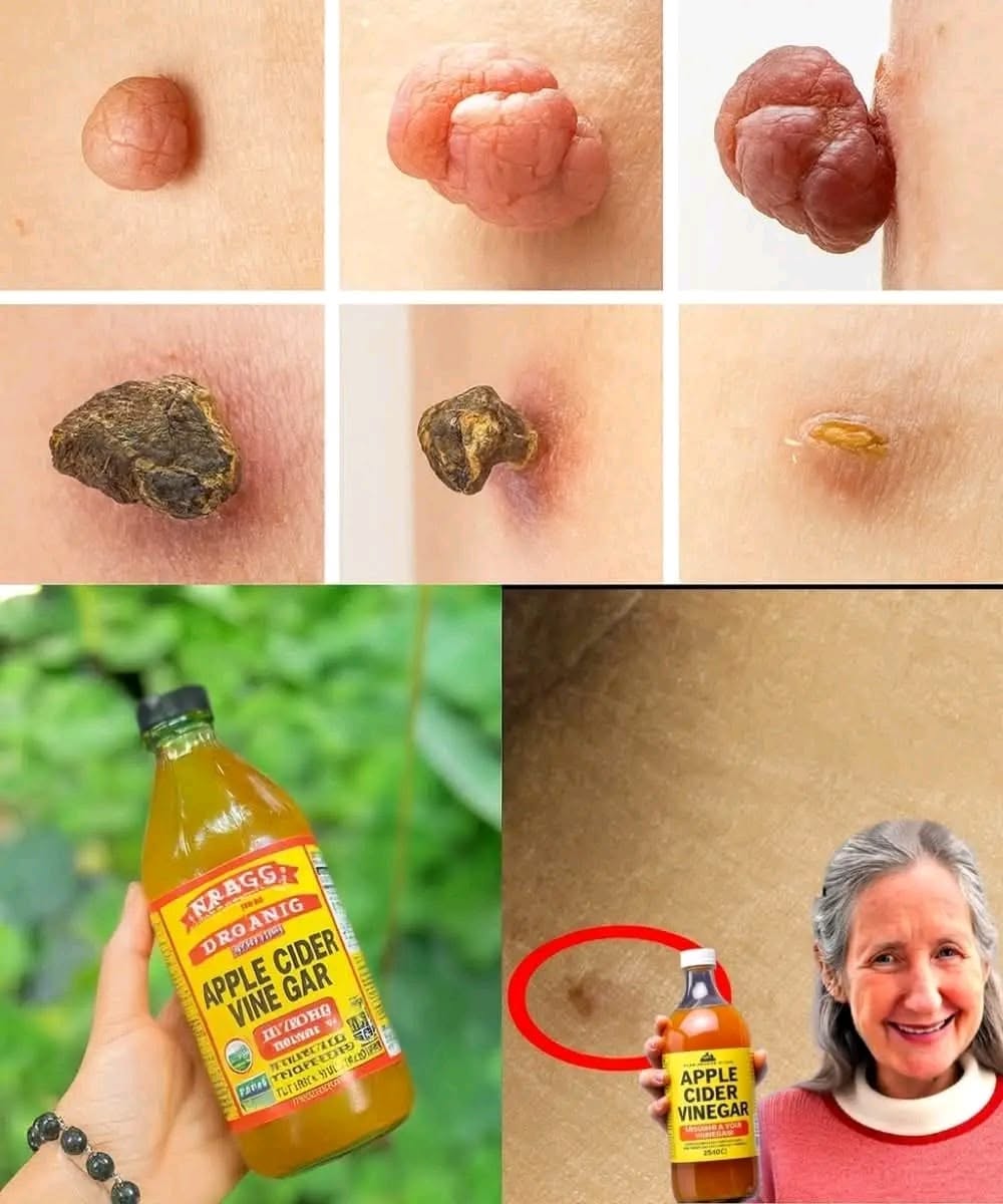 Plantar Warts and Skin Tags Disappear Naturally—Try This Overnight Remedy