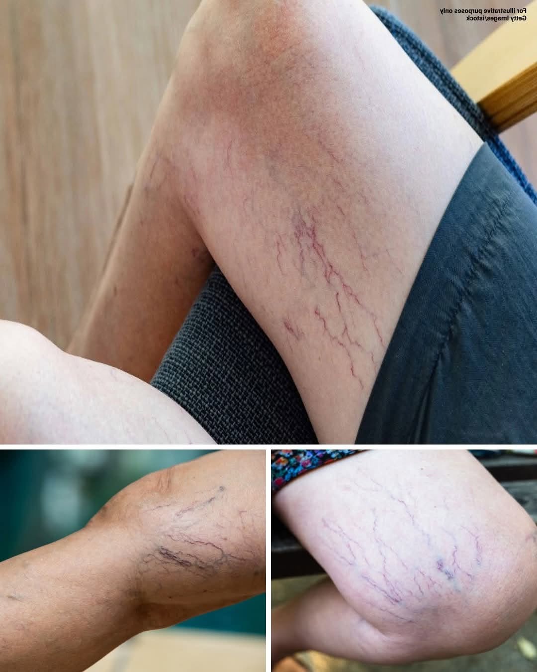 If you have purple veins on your legs, it means you are…